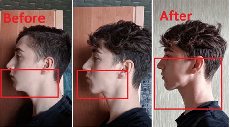 mewing results